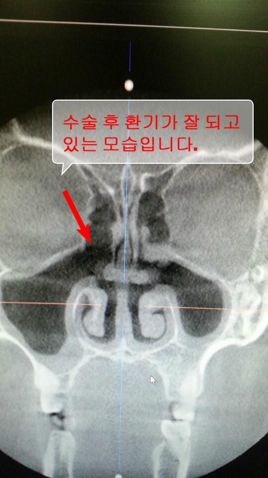 2 수술 후 축농증 CT.jpg